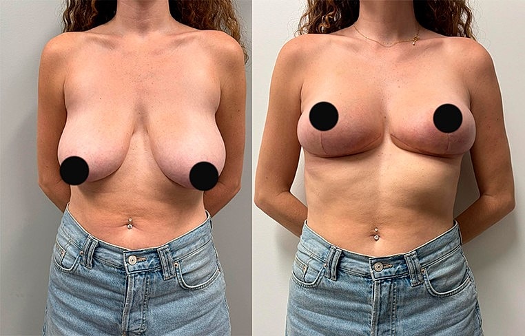 Before and after body image comparison.