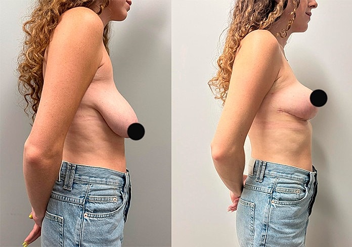 Before and after breast surgery comparison image.