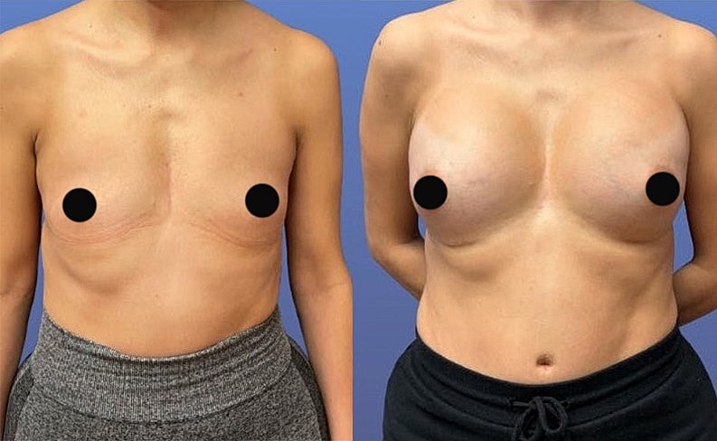 Side views of a woman's torso, post-surgery.