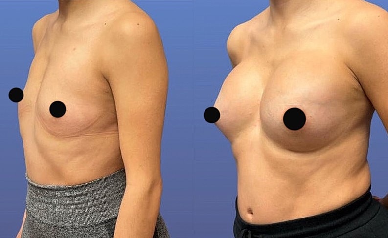 Before and after breast surgery comparison image.