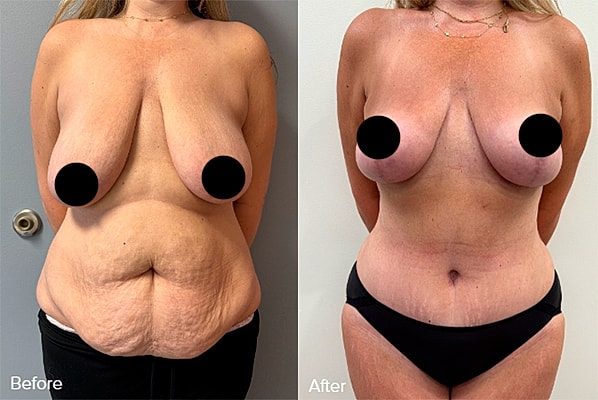 Side views of a woman's torso, post-surgery.