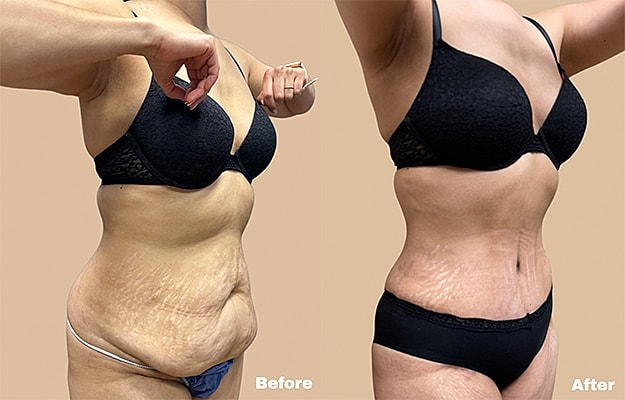 Before and after body image comparison.