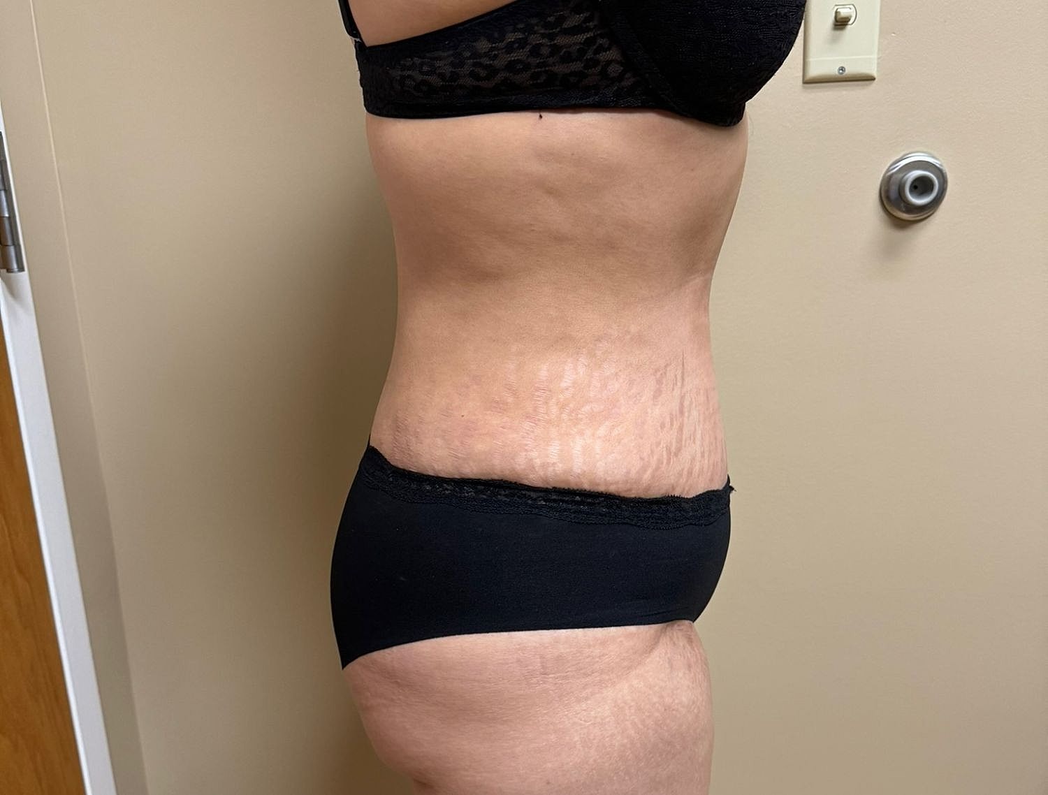 Mommy Makeover Before & After