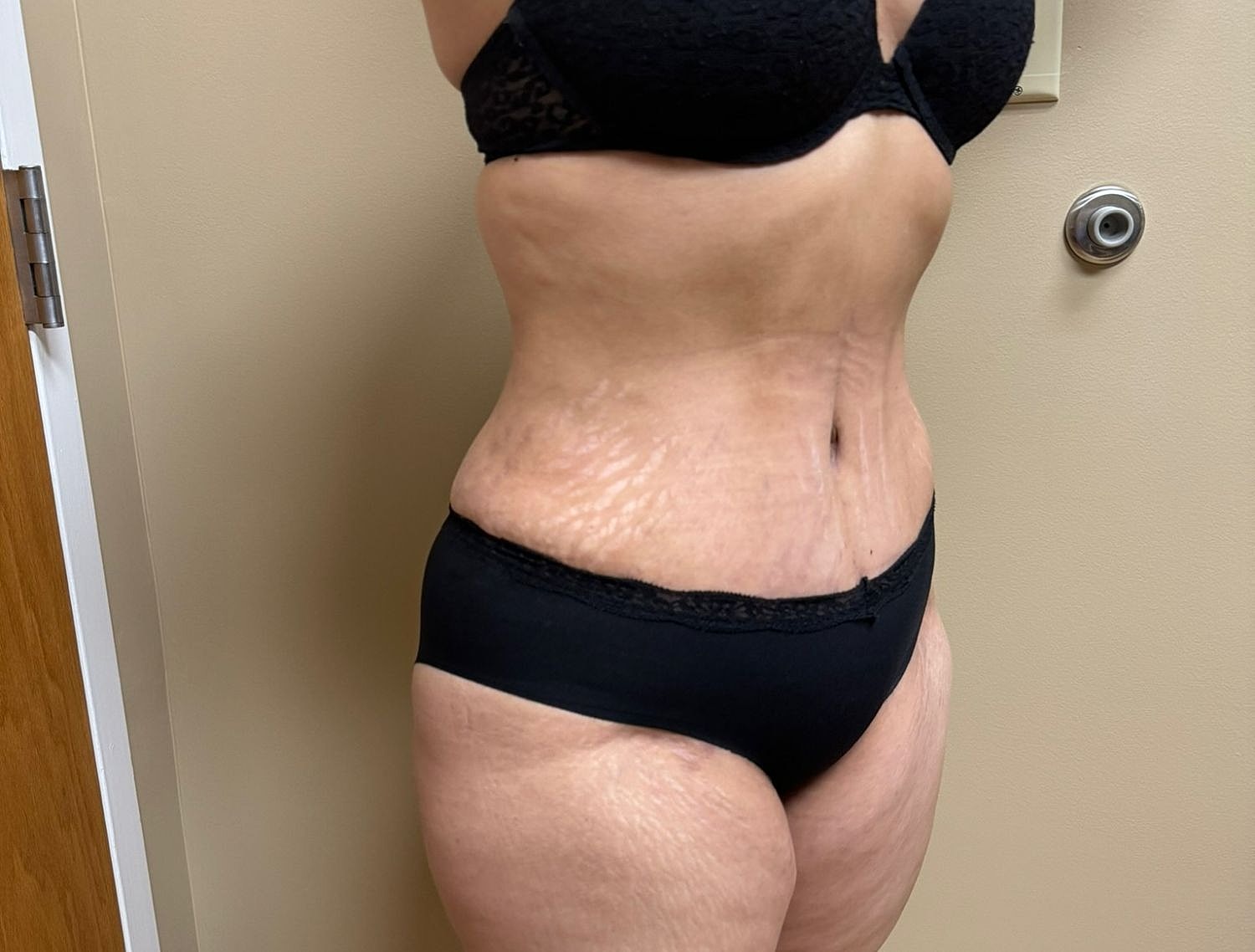 Mommy Makeover Before & After