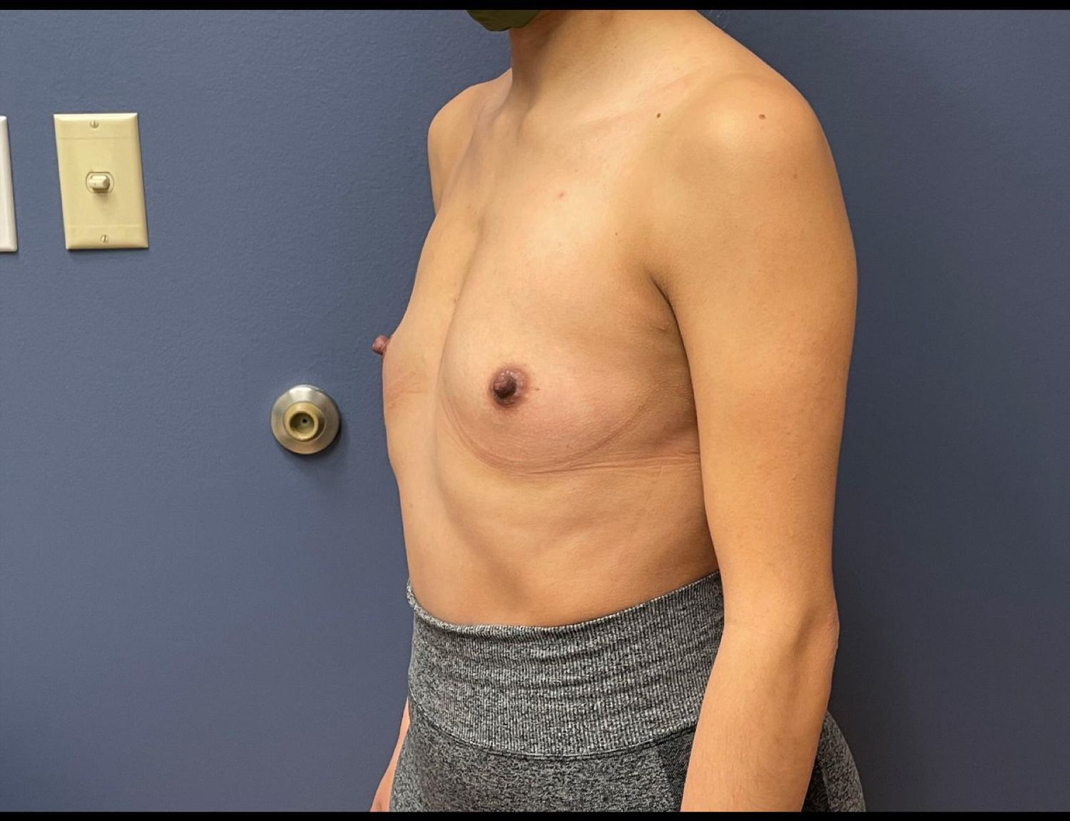 Breast Augmentation Before & After