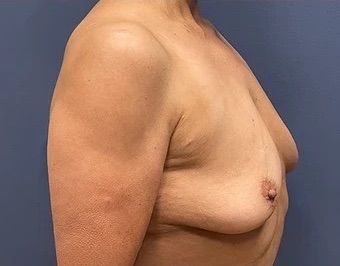 Breast Augmentation Before & After