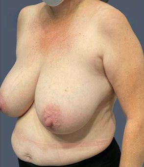 Breast Reduction Before & After