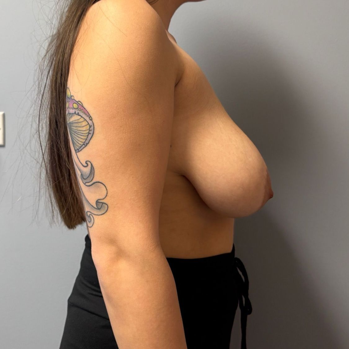 Breast Reduction Before & After