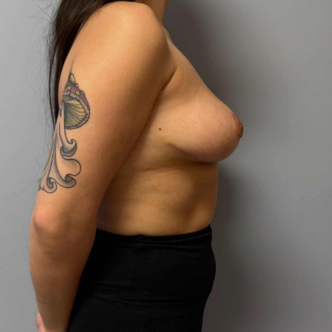 Breast Reduction Before & After