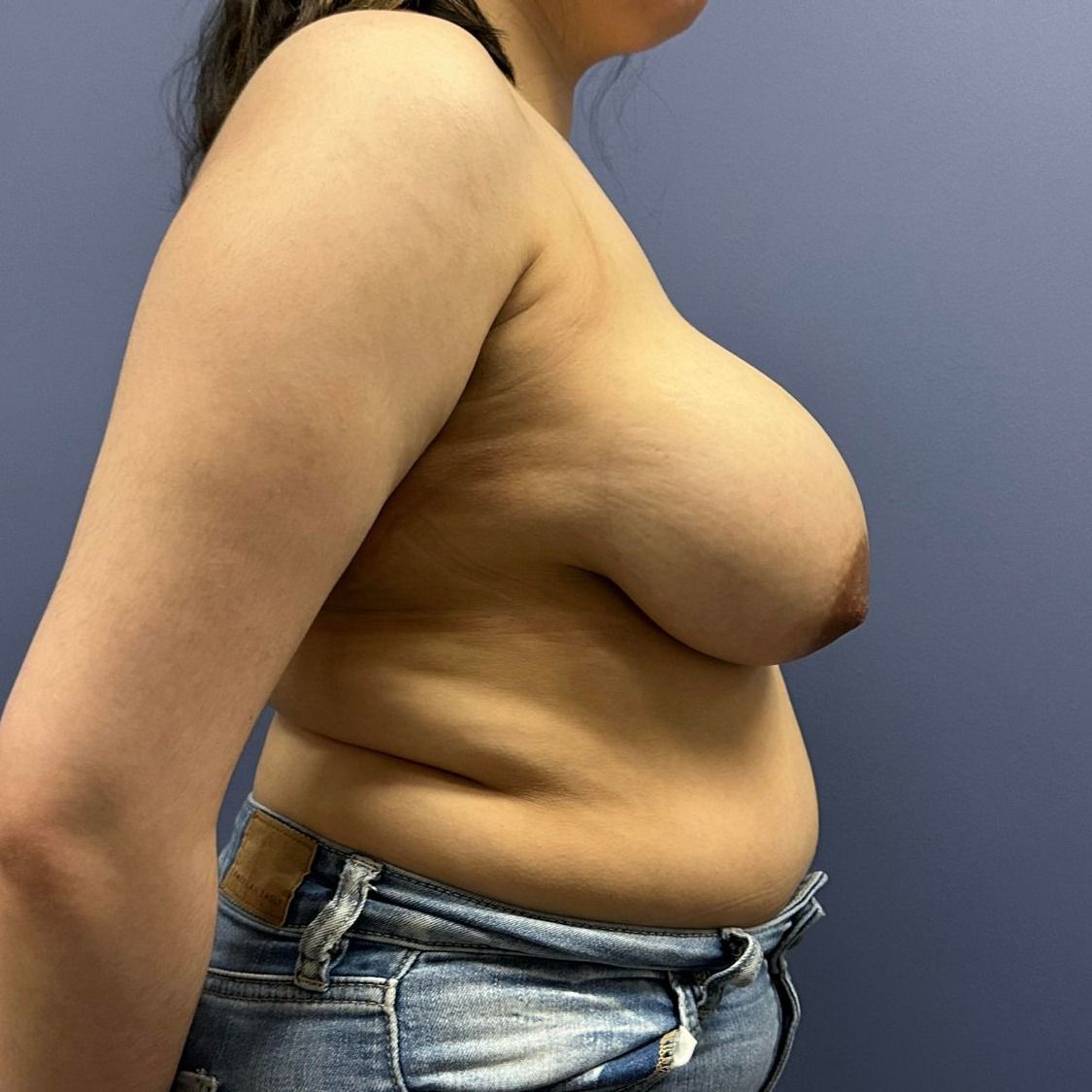 Breast Reduction Before & After