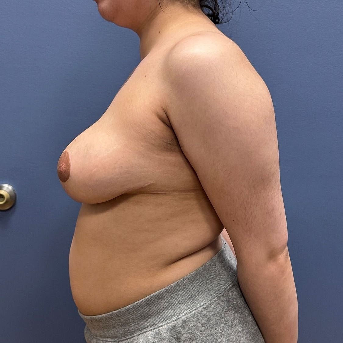 Breast Reduction Before & After