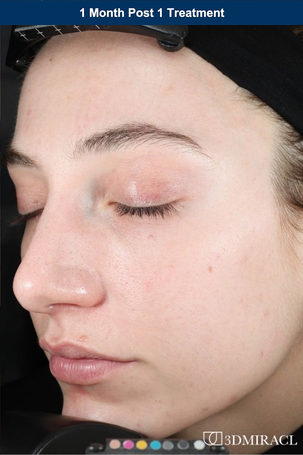 UltraClear Laser Before & After