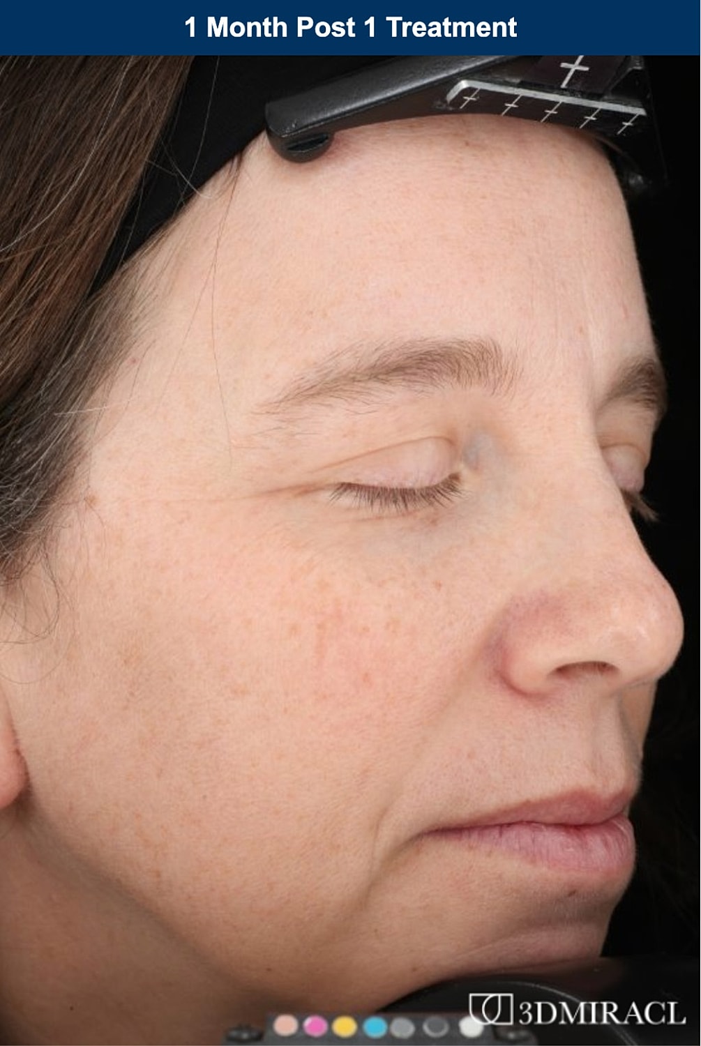 UltraClear Laser Before & After