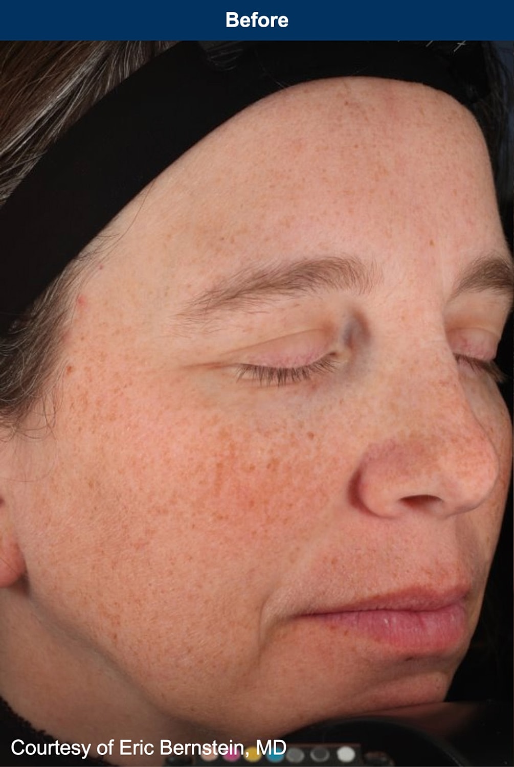 UltraClear Laser Before & After