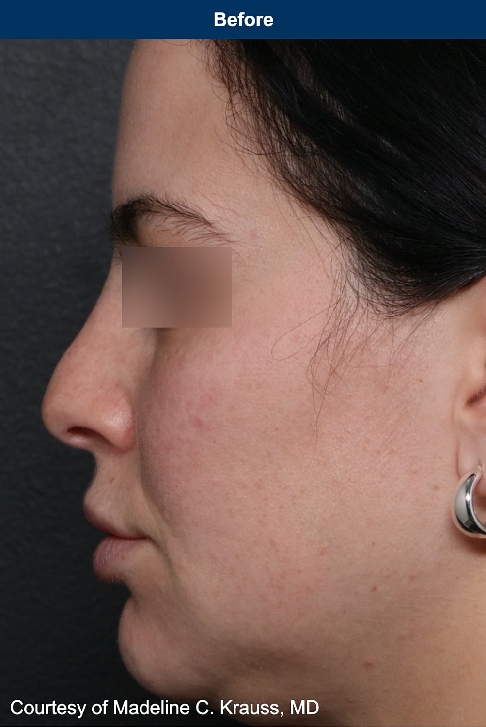 UltraClear Laser Before & After