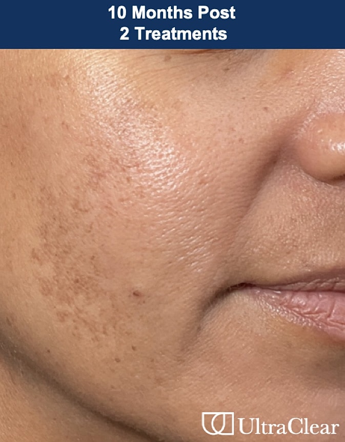 UltraClear Laser Before & After