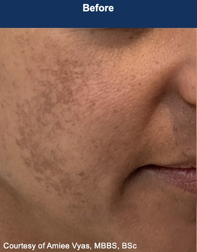 UltraClear Laser Before & After