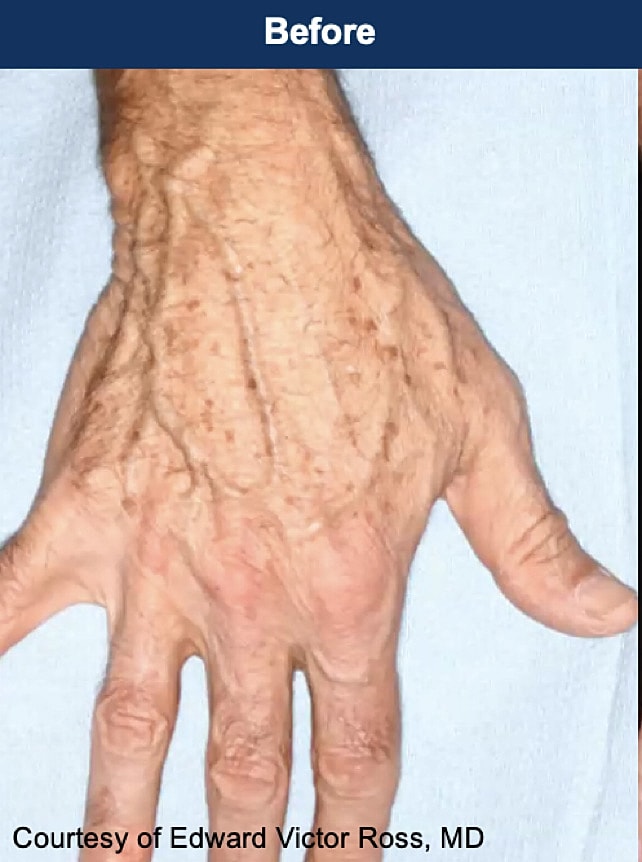 UltraClear Laser Before & After