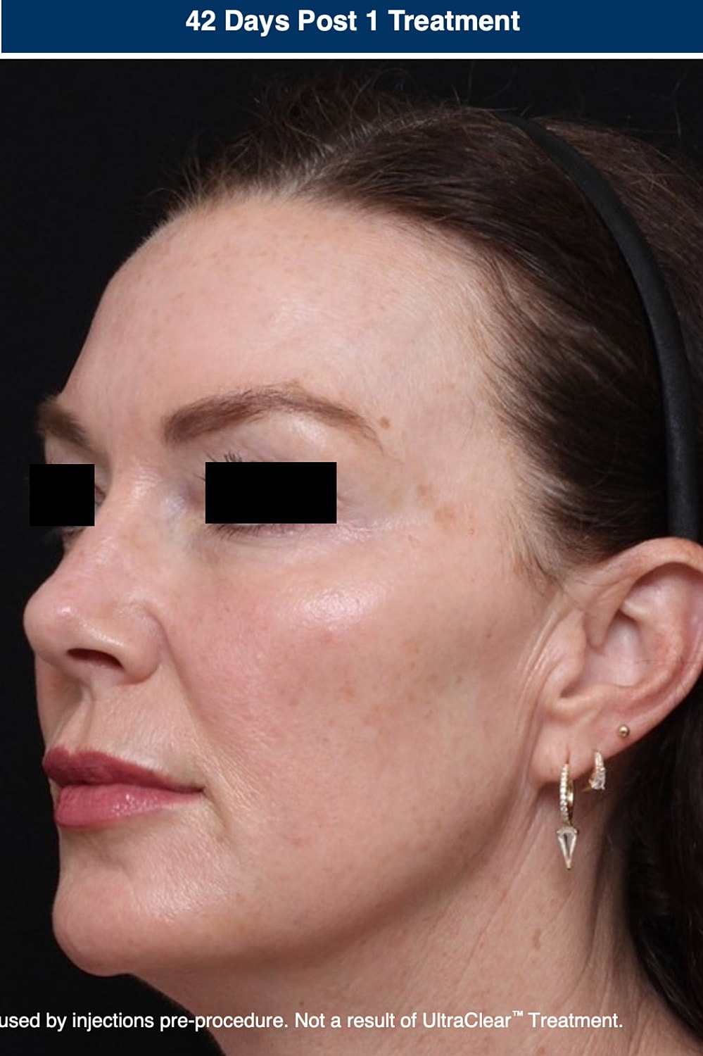 UltraClear Laser Before & After