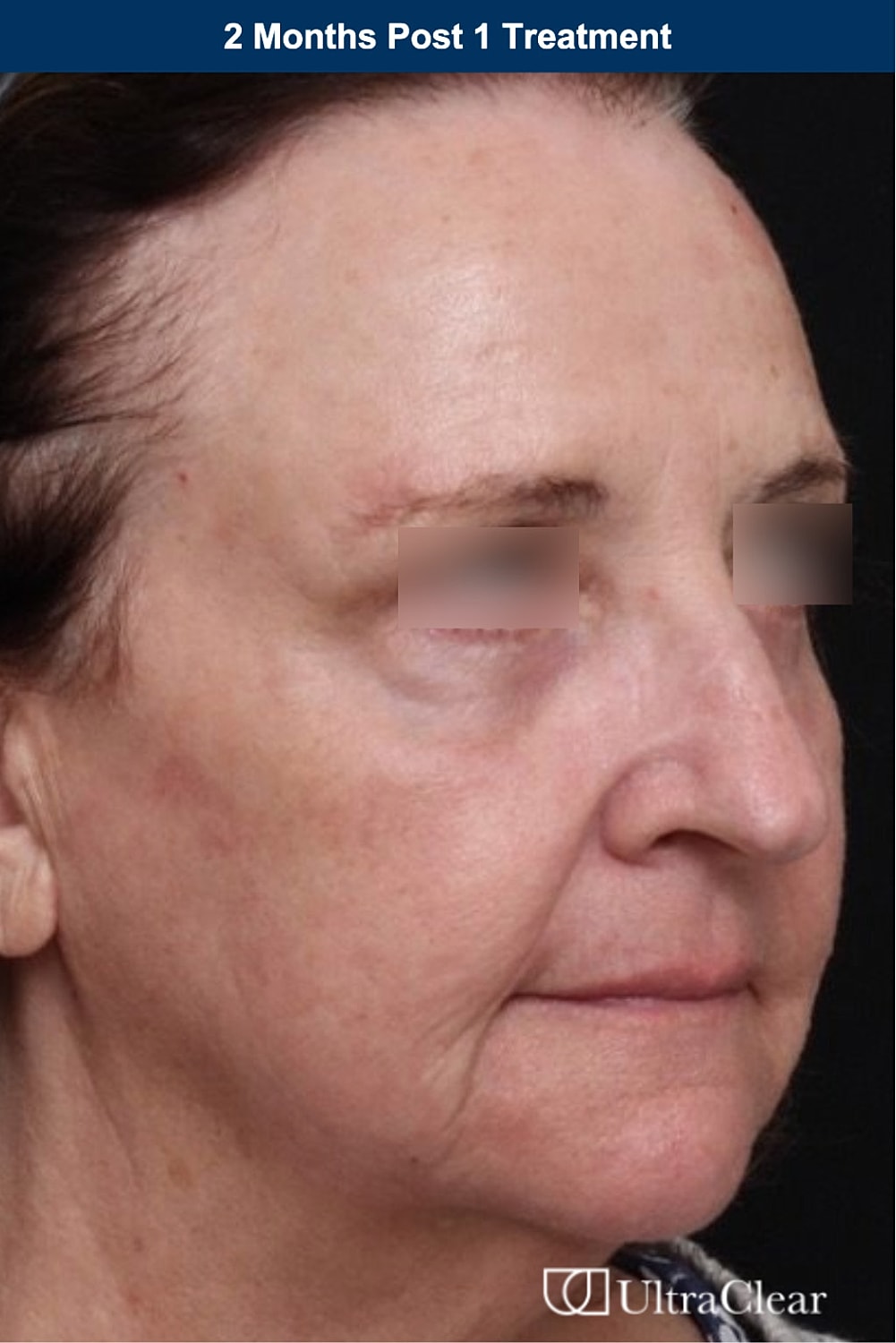 UltraClear Laser Before & After