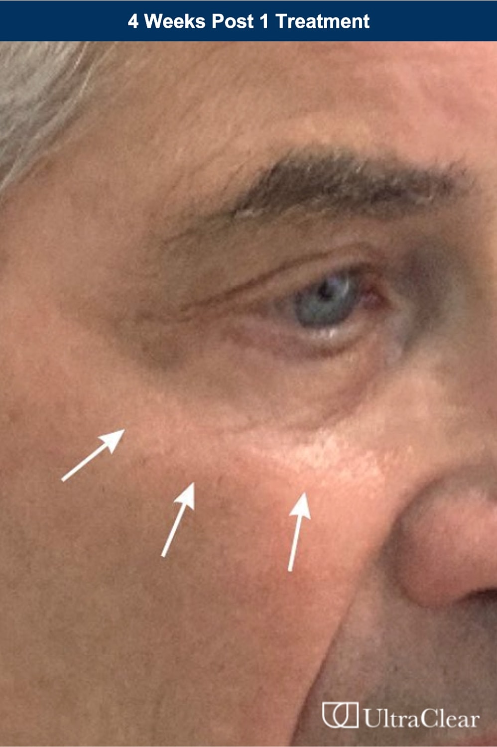 UltraClear Laser Before & After