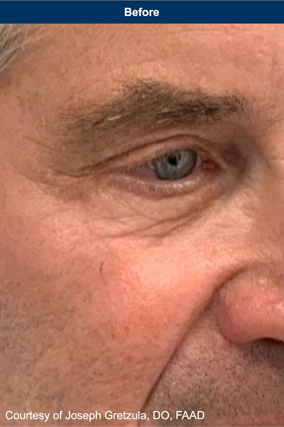 UltraClear Laser Before & After