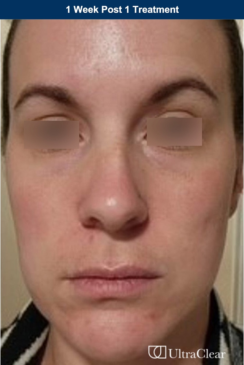 UltraClear Laser Before & After