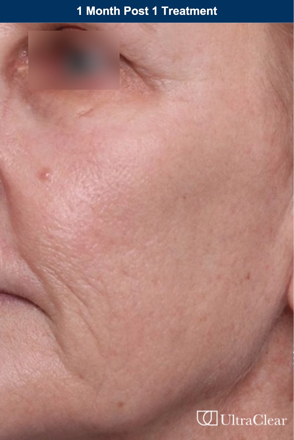 UltraClear Laser Before & After