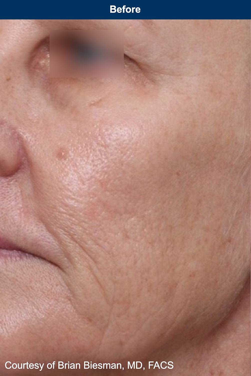 UltraClear Laser Before & After