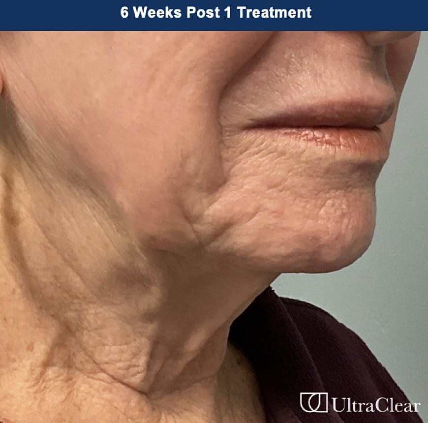 UltraClear Laser Before & After