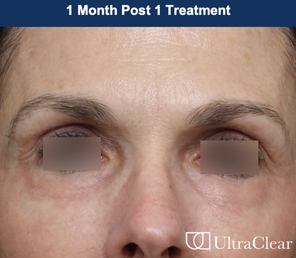 UltraClear Laser Before & After