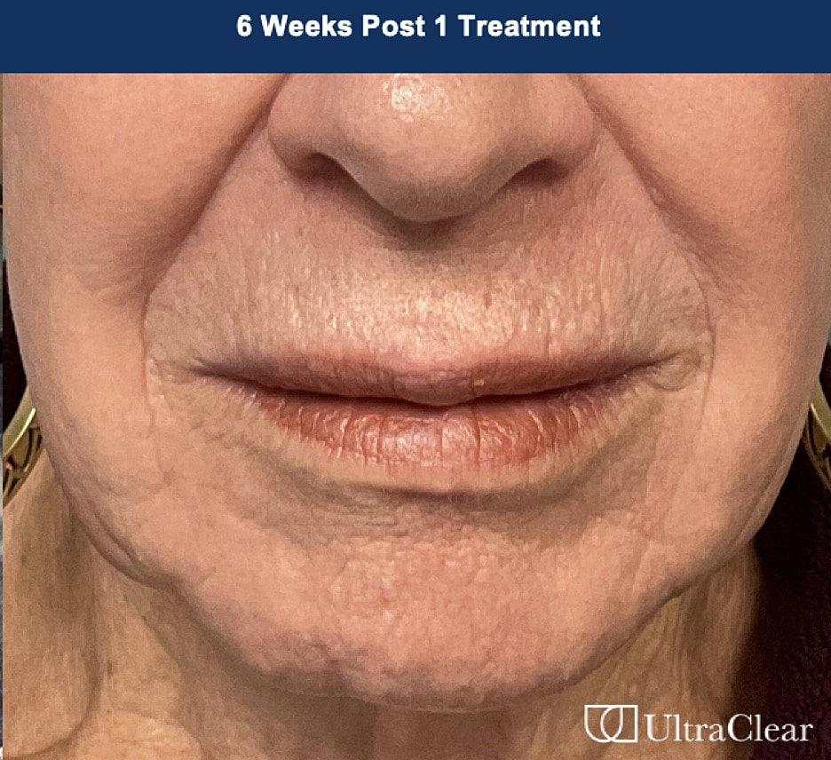 UltraClear Laser Before & After