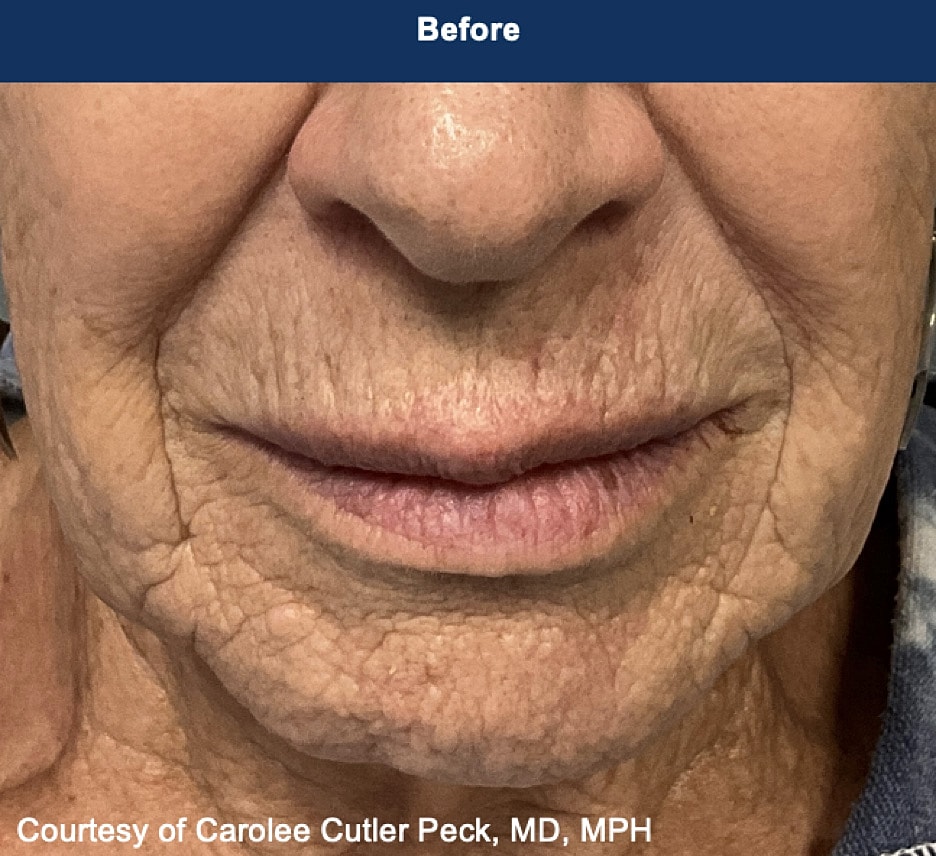 UltraClear Laser Before & After