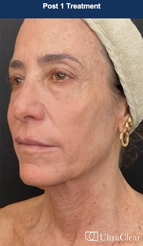 UltraClear Laser Before & After