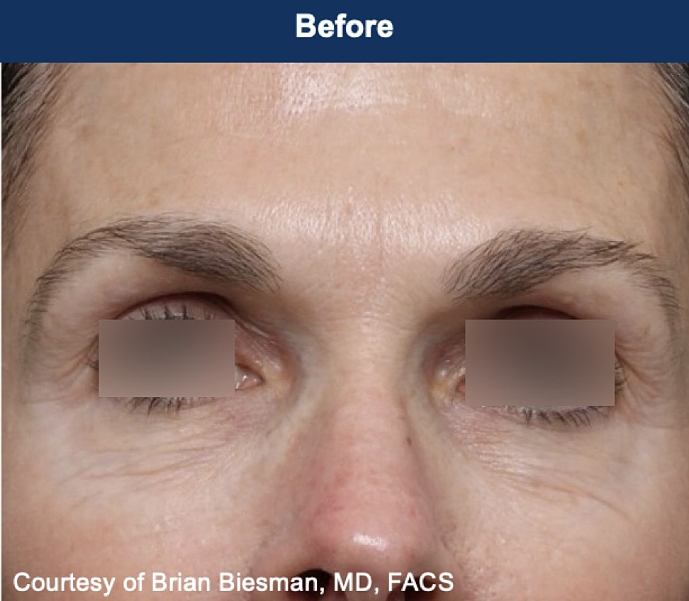 UltraClear Laser Before & After