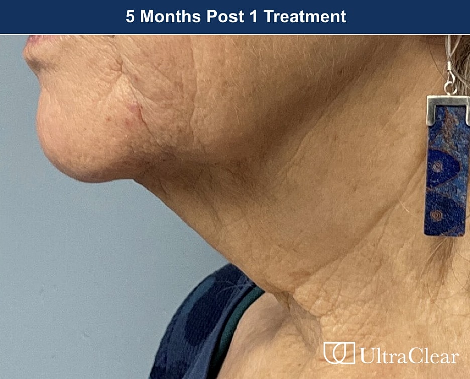 UltraClear Laser Before & After