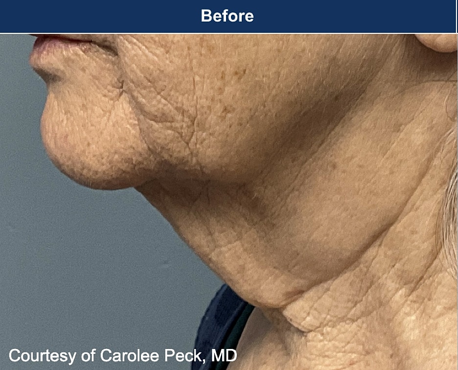 UltraClear Laser Before & After