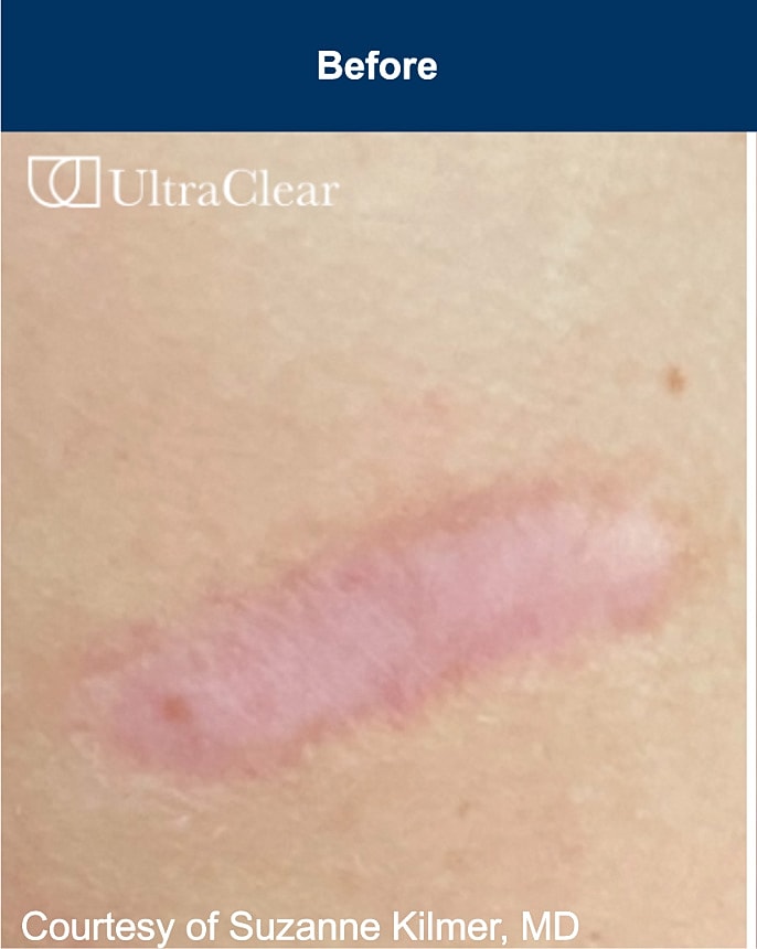 UltraClear Laser Before & After