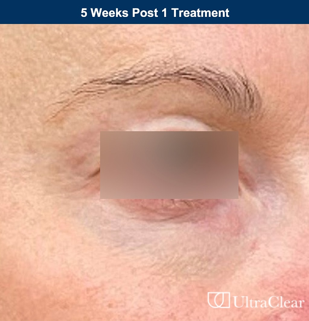 UltraClear Laser Before & After