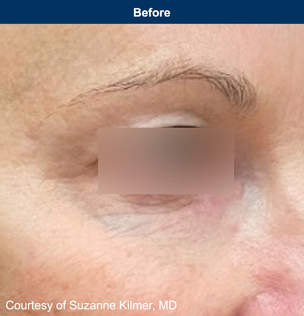 UltraClear Laser Before & After