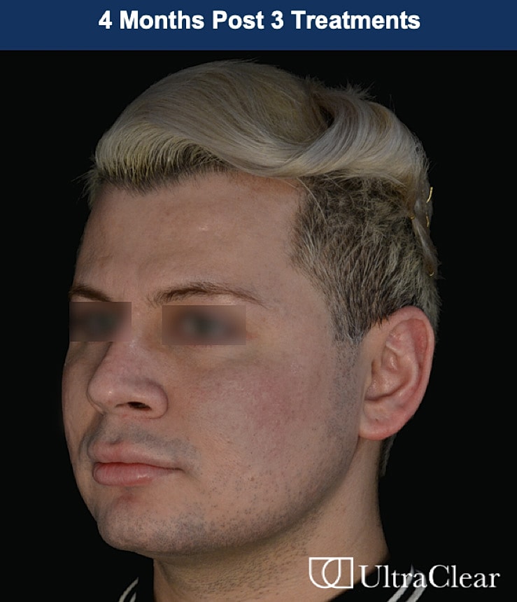 UltraClear Laser Before & After