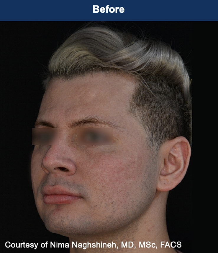 UltraClear Laser Before & After