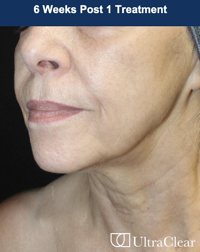 UltraClear Laser Before & After