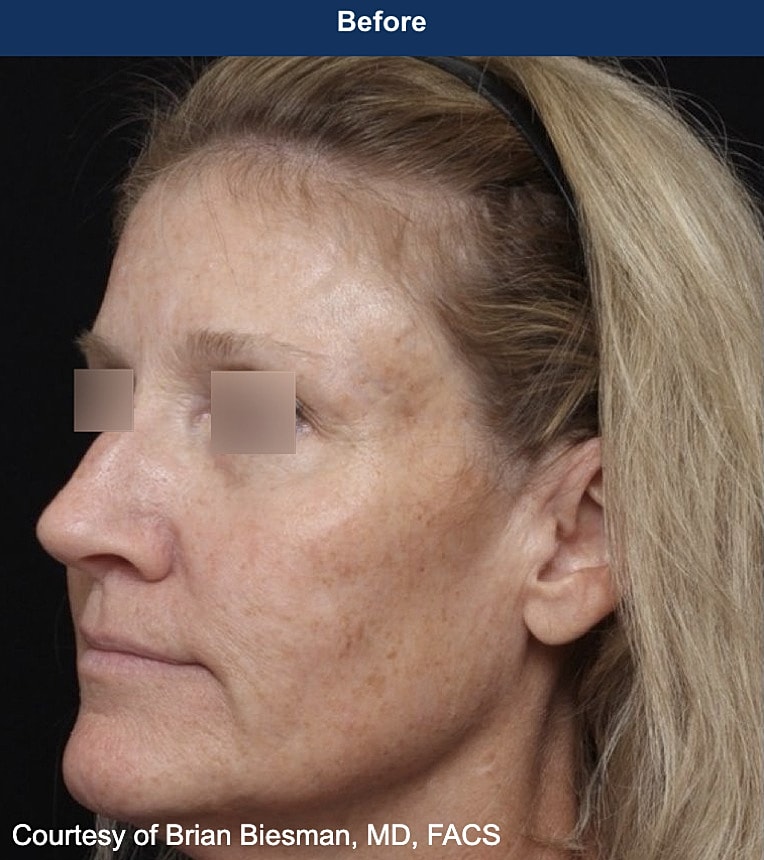 UltraClear Laser Before & After