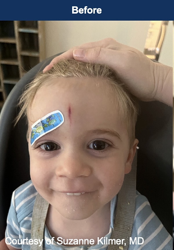 UltraClear Laser Before & After