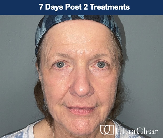 UltraClear Laser Before & After