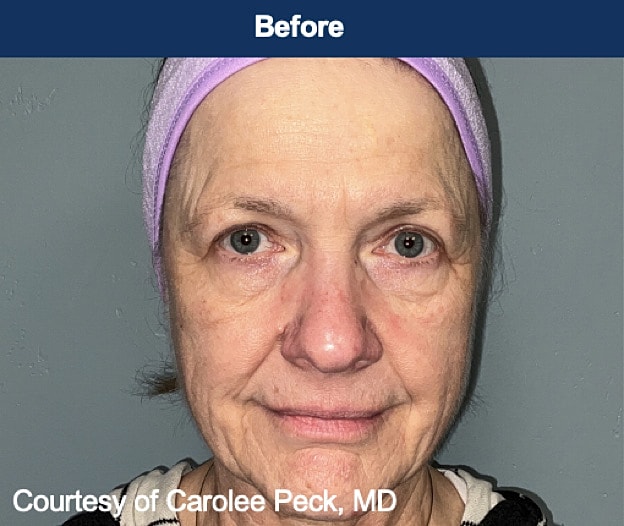 UltraClear Laser Before & After