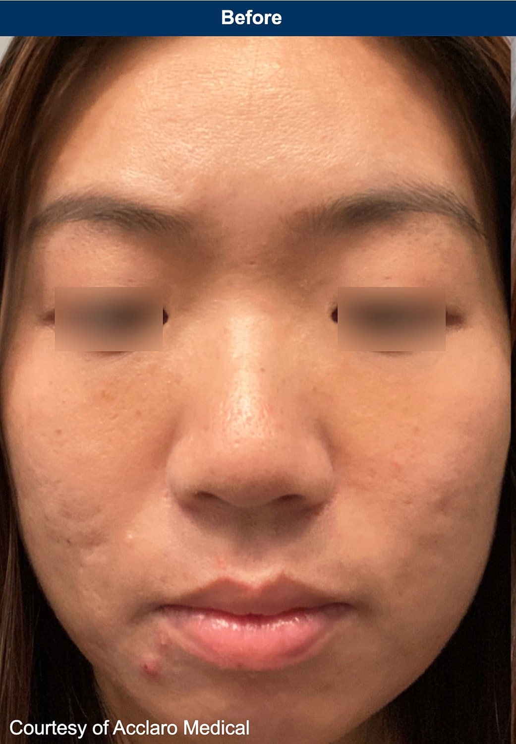 UltraClear Laser Before & After