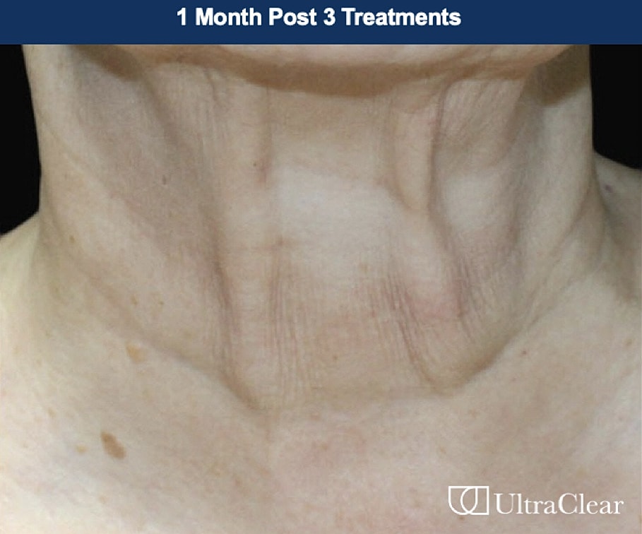 UltraClear Laser Before & After