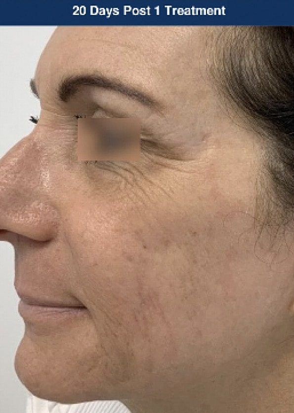 UltraClear Laser Before & After